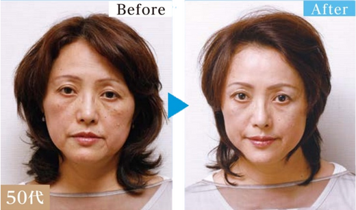 シワ・タルミに特化した美顔施術「ボワールリフティング®」