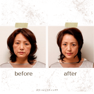 「ボワールリフティング®」認定サロンで、リフトアップを実感♪