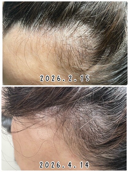 生え際の薄毛が気になる方も変化が！