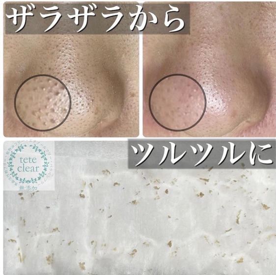 毛穴の黒ずみがこんなにも！思っている以上に毛穴って汚れが詰まってます！角栓根こそぎスペシャルコースでごっそり！！